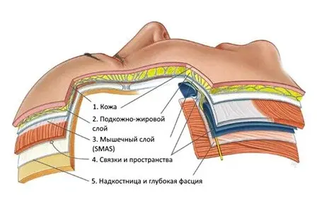 Ультразвуковой смас-лифтинг UltraFormer MPT Ультразвуковой смас-лифтинг UltraFormer MPT