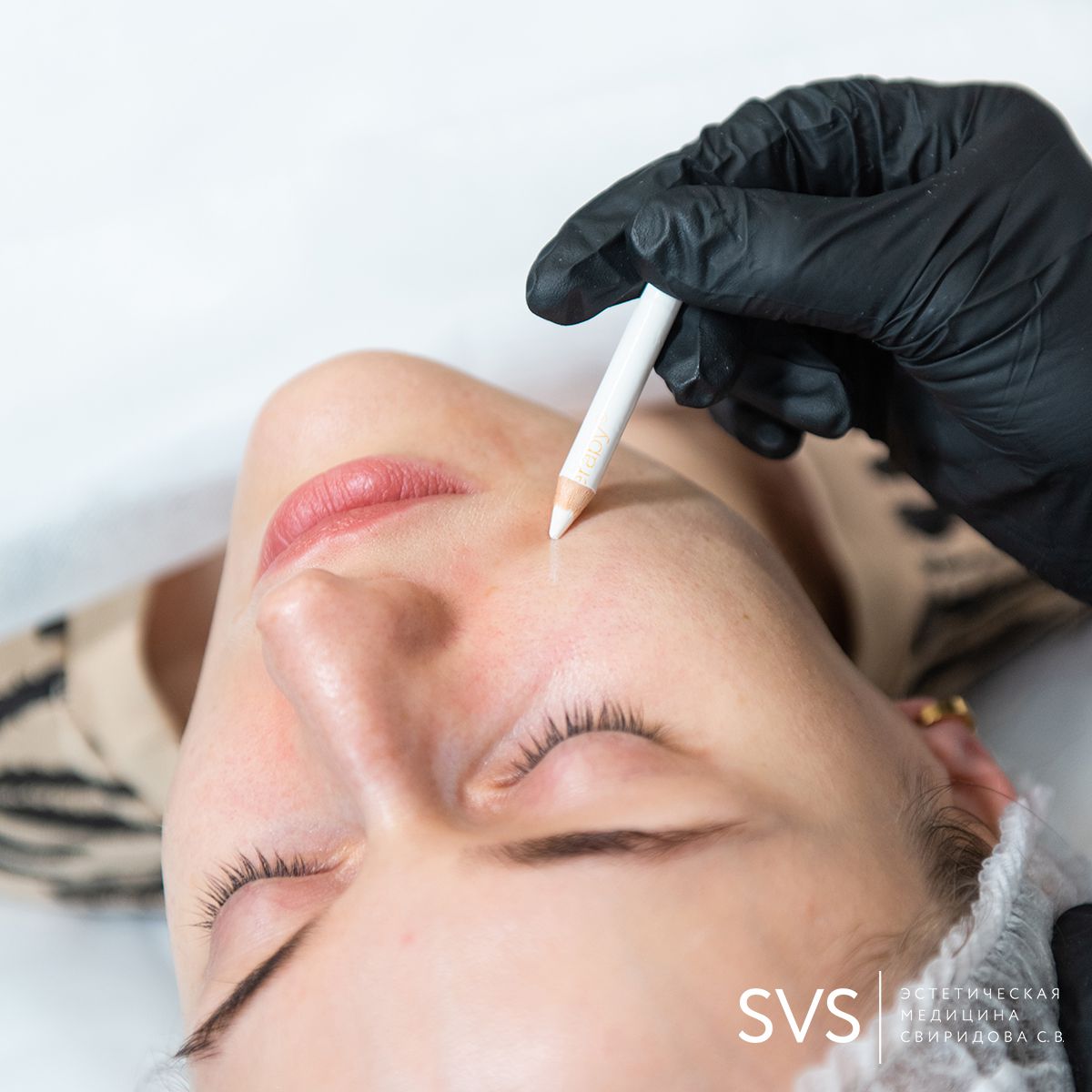 SMAS-лифтинг SMAS-лифтинг